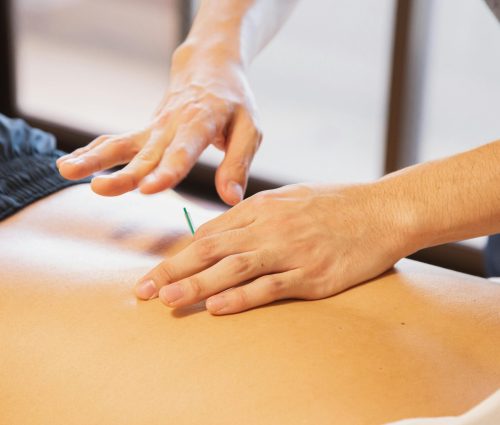 Acupuncture